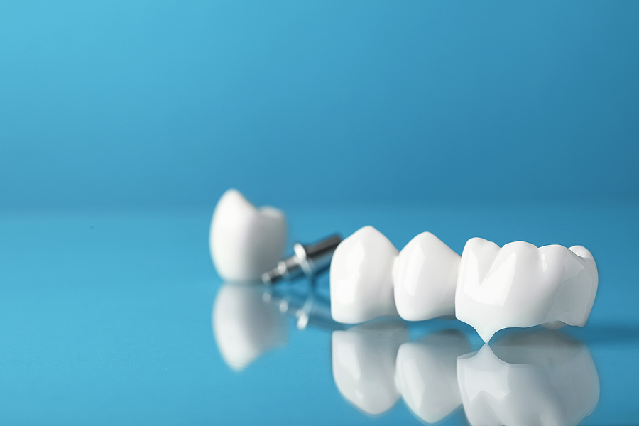 A Complete Guide to Dental Crowns: Restoring Your Smile with Confidence