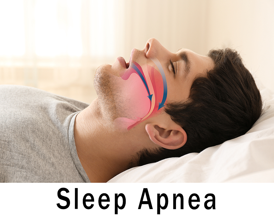 Sleep Apnea: Causes, Symptoms, and Effective Treatment Options in Tyler, TX
